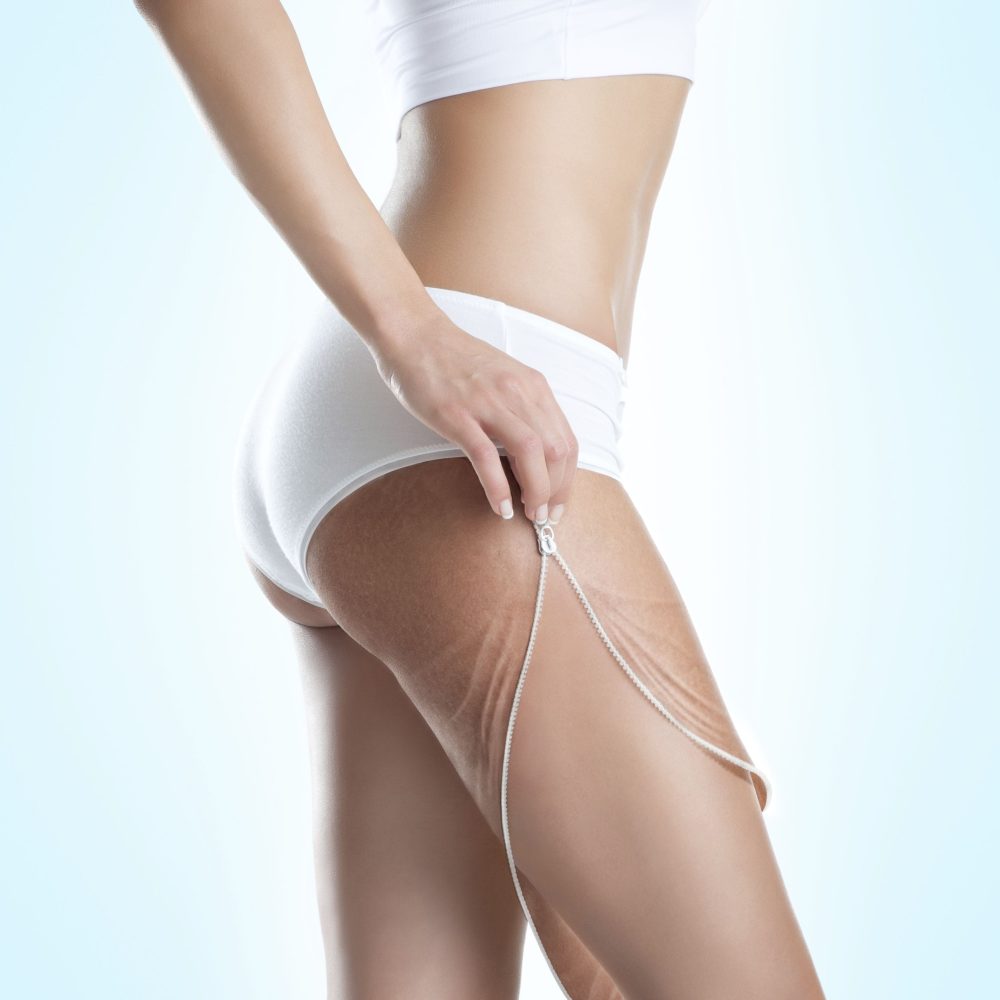 CeluStoper® HOME de la Mia Calnea, performanța anticelulitică la tine acasă